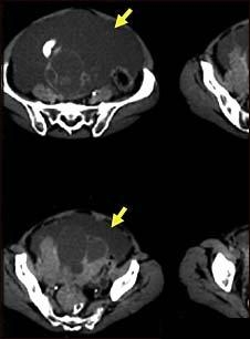 Cancerul cailor biliare extrahepatice